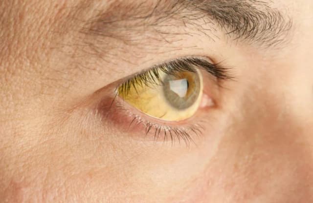 Zespół Gilberta a objawy psychiczne – co warto wiedzieć? Zespół Gilberta a objawy psychiczne – co warto wiedzieć?