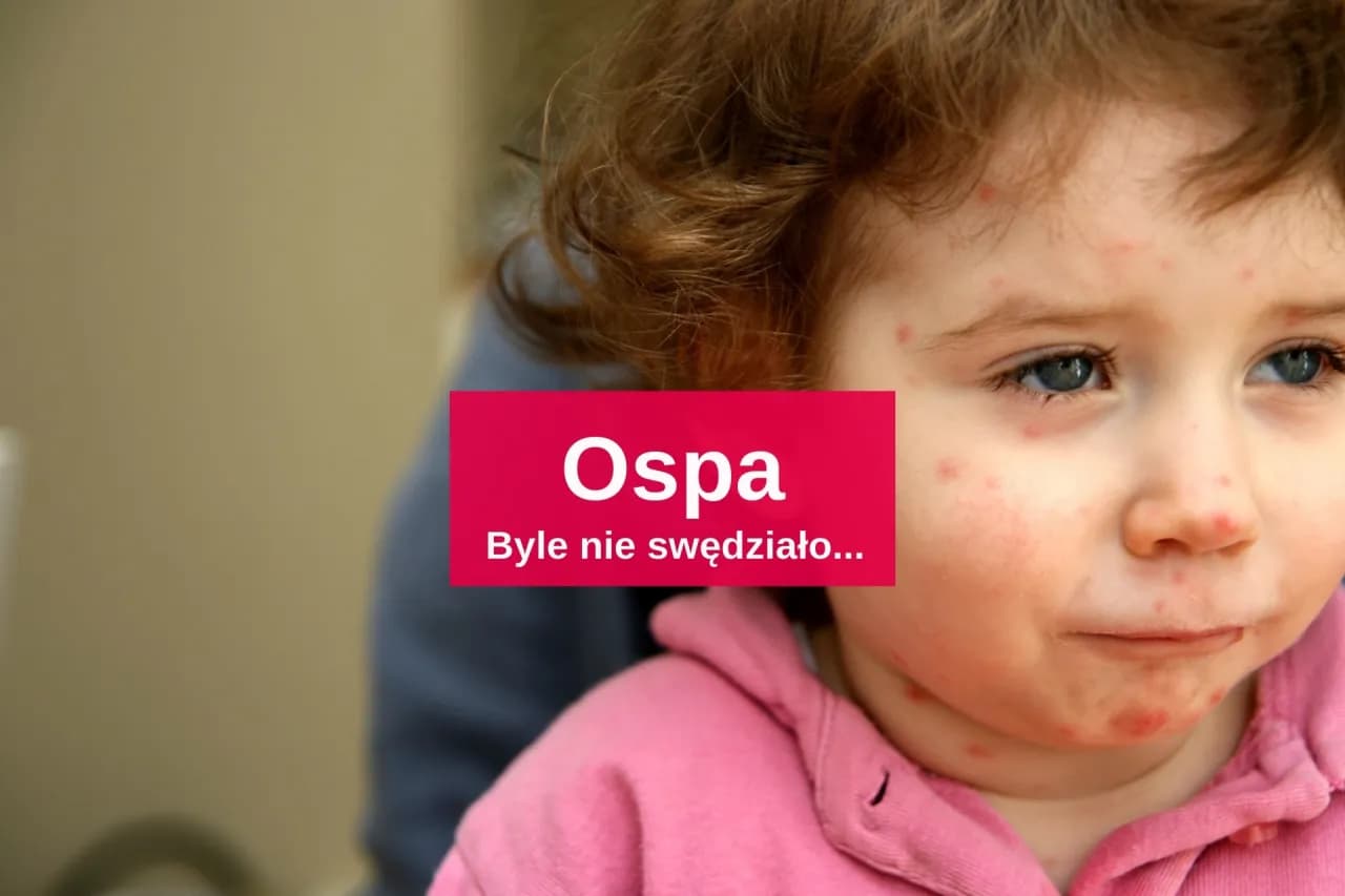 Skuteczne leki na ospe - jak złagodzić objawy i przyspieszyć leczenie Skuteczne leki na ospe - jak złagodzić objawy i przyspieszyć leczenie
